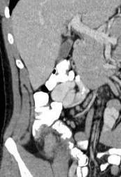 cor, thick cecum, nl TI