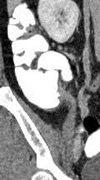 coronal