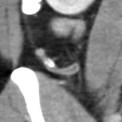 mid-dist appy w lith, enhanc