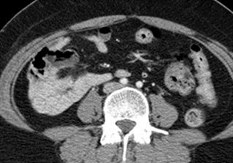 Incidental Malrotation, CT-8
