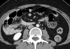 Incidental Malrotation, CT-7