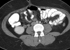 Rt ov w vein thrombosis, appy
