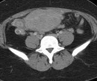 Rt ov w vein thrombosis