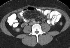 Rt ov w vein thrombosis, appy