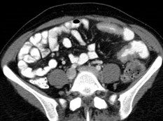 LLQ Crohn's