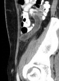 Follow up, rec pain 3-30-08 3 sag