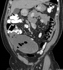 First CT 1