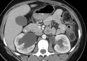 trv kidneys.jpg