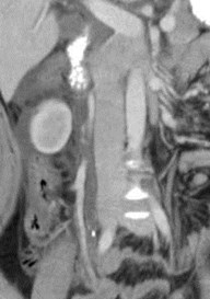 3 cor R ureter w calc