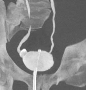 bladder MIP