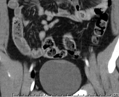 routine CT, cor bladder wall thickening.jpg