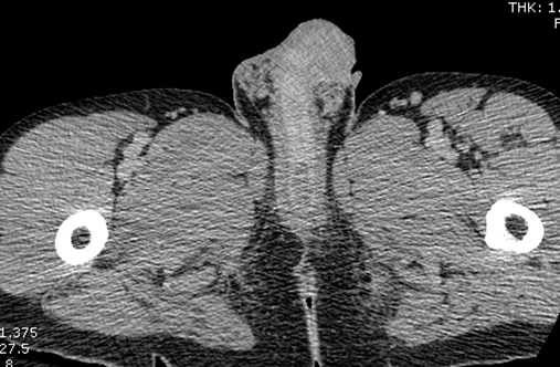 3 CT, urethral injury in retrospect.jpg