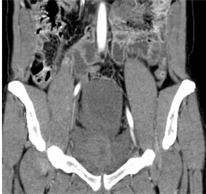 first CT coronal bladder elevated in pelvis.jpg