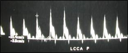 LCCA doppler-7