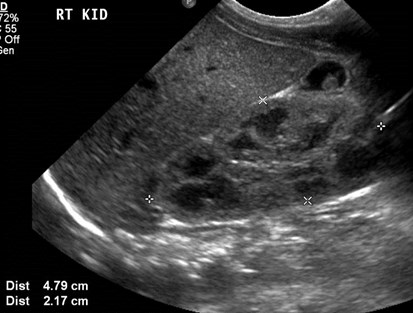 Rt kidney