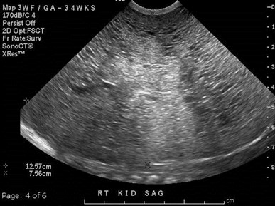 sag rt kid