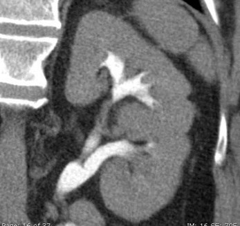 LT Kidney Cor 2