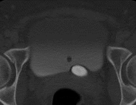 C upper pole in ureterocele w stone
