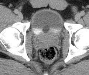 prostatic cyst-2