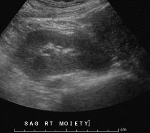 Sag Rt moiety 2