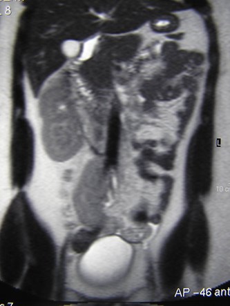 Mackie crossed renal ectopia-1