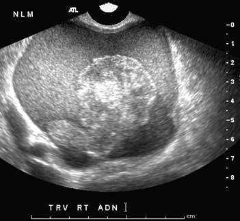 TV Rt adnexal mass.jpg
