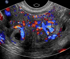 UT w ectopic  2