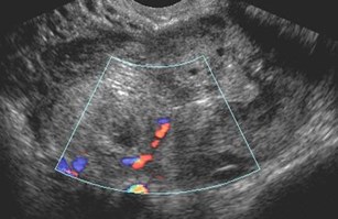 trv R ectopic w flow