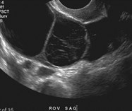 ROV cysts