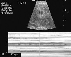 culdesac w ectopic-2