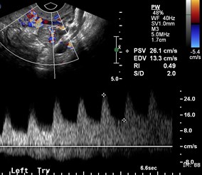 color, Doppler of ectopic.jpg