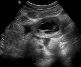 7-3 small fluid around ectopic