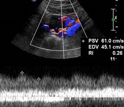 pulsed Doppler