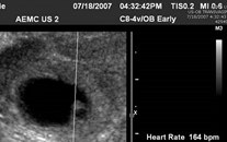 7-18 interval growth w cardiac act