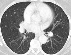 chest CT lung mets