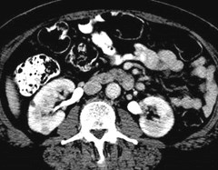 bilat renal masses CT