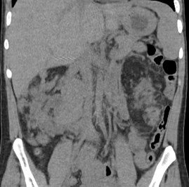 CT kidneys 1.jpg