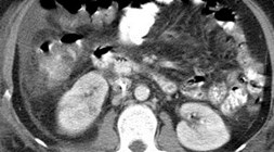 First CT w areas of pyelo