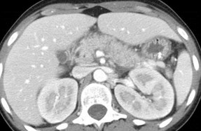 Sinclair, Shemeka, pancreatitis simul L renal mass-CT-4