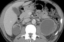 CT thickwalled Lcyst, thin on R