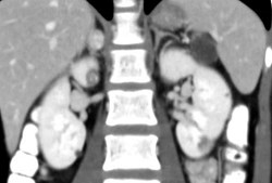 CT cor kidneys and adrenal 2