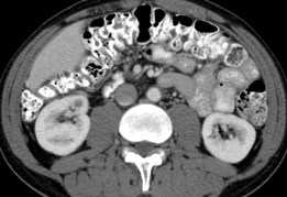 R  Renal Mass 7-07.jpg