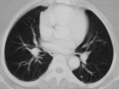 C:\WINDOWS\DESKTOP\New Folder\HRCT shows calc nodule\lung normal .jpg