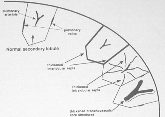 X:\New Folder\HRCT diagram 003.jpg