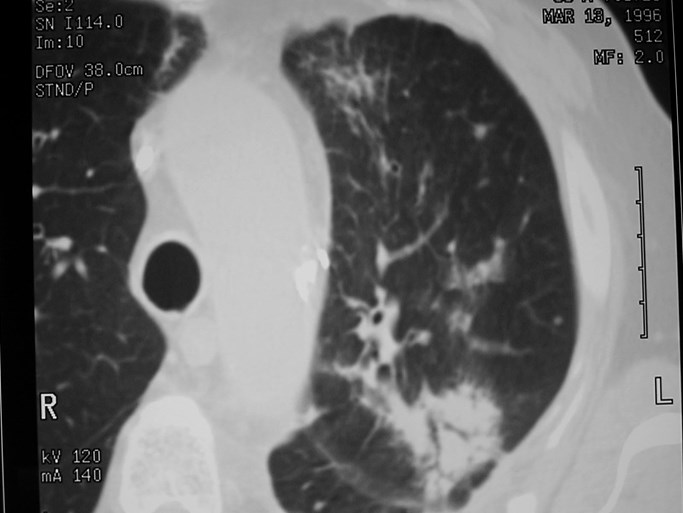 XRT pneumonitis                                                0000F615Macintosh HD                   ABA78158: