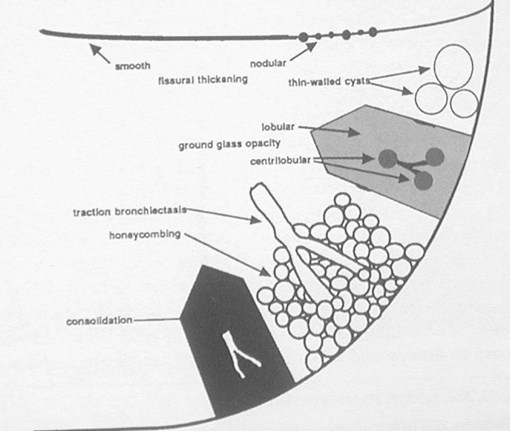 X:\New Folder\HRCT diagram 003.jpg