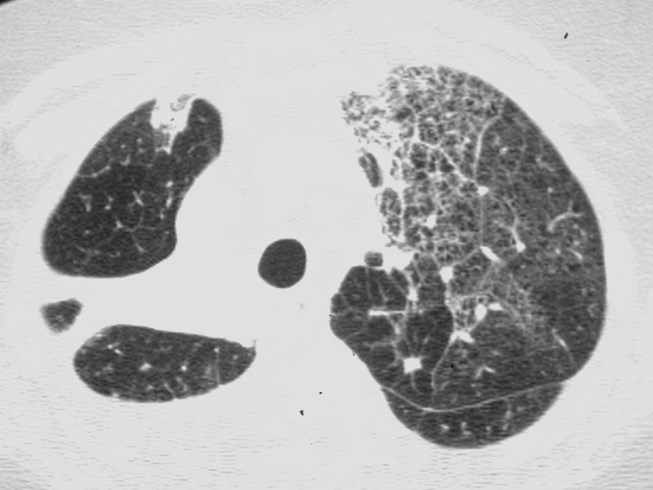 lymphangitic lung ca                                           0000F6AEMacintosh HD                   ABA78158: