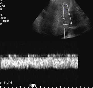 MHV Doppler