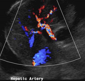 prom hepatic arteries