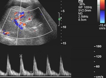 Doppler hep a